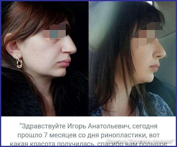 отзыв ринопластика 5.jpg
