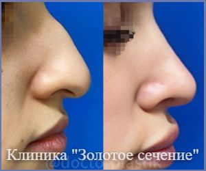 пример результата операции ринопластики