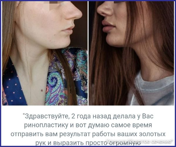 отзыв ринопластика 1.jpg