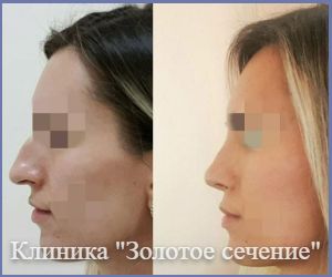 результат операции ринопластике после 5 месяцев