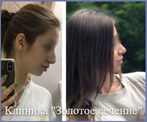 пример результата операции ринопластики