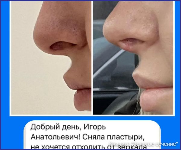 отзыв ринопластика 4.jpg