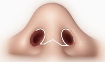 rinoplastika_open.jpg rinoplastika_open.jpg