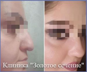 пример результата операции ринопластике