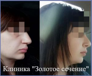 пример результата операции ринопластике