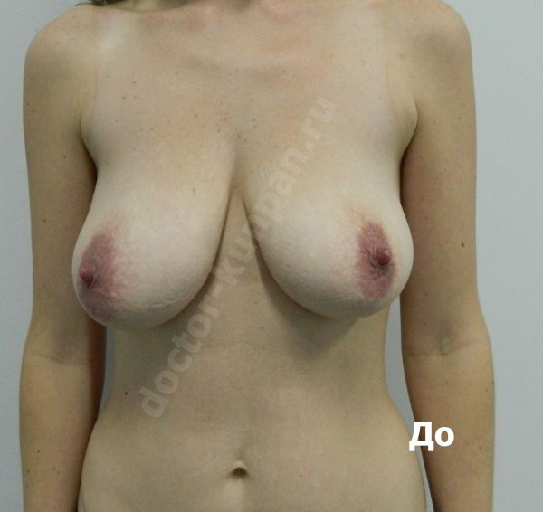 Подтяжка груди (до)