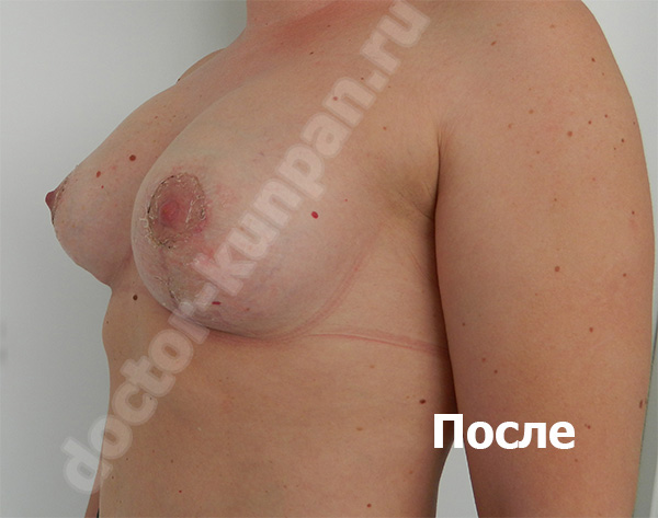 Увеличение груди с подтяжкой (после)